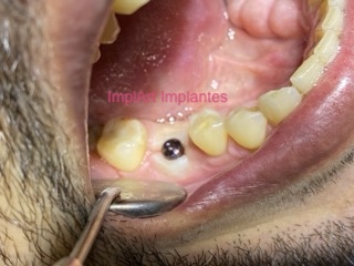 As Variações Genéticas que Podem Comprometer o Sucesso de um Implante Dentário