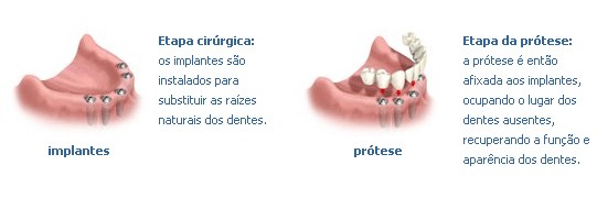 implante dentario como é feito
