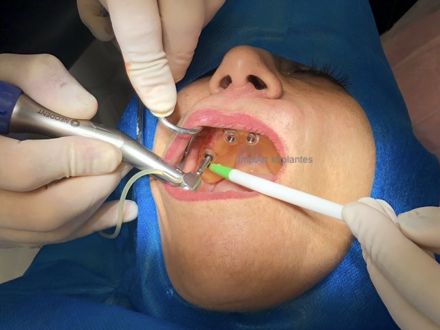 cirurgia guiada implante