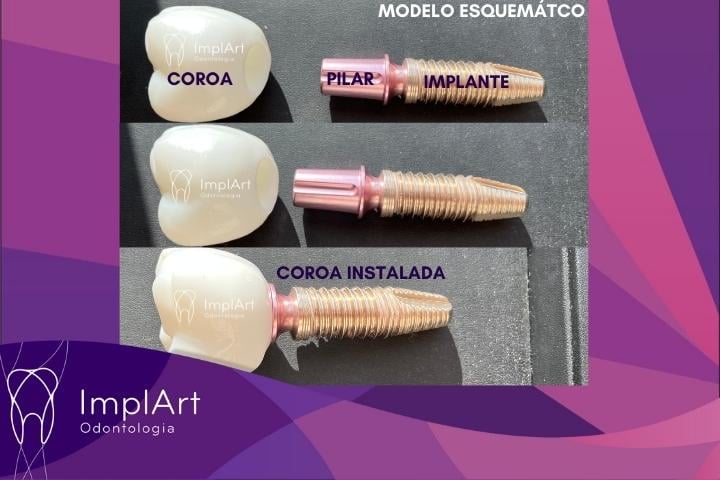 implante dentário sem parafuso