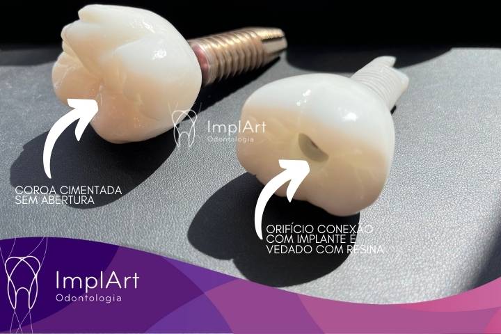 implantes sem parafuso